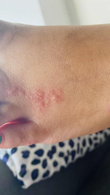 Underarm Rashes hi mga ka mommies. Sino naka experience dito.